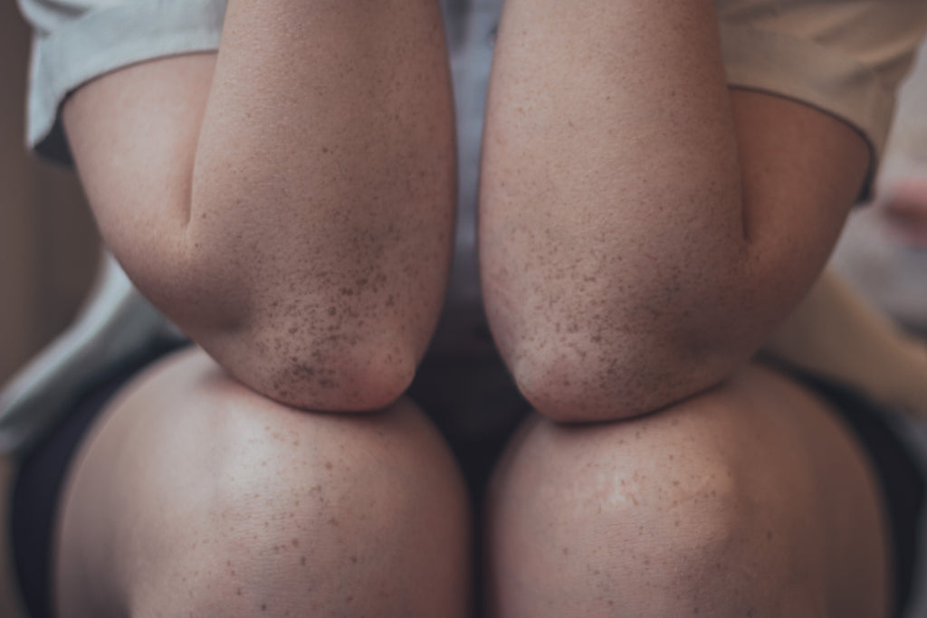 Typiske problemområder ved psoriasis